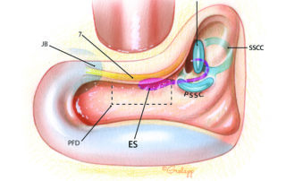 In preparation for exposure of the endolymphatic sac, an intact canal wall mastoidectomy is performed. In contrast to many drawings which appear in otologic texts, the sac does not reside on the posterior fossa dura superficially in the mastoid. Instead it is positioned rather medially and sits inferior to the labyrinth. Surgical exposure of the sac is carried out through a roughly rectangular window (dashed line) which, when pneumatized, is known as the retrofacial air cell tract. This is bounded anteriorly by the mastoid segment of the facial nerve, posteriorly by the posterior fossa dura, superiorly by the posterior semicircular canal, and inferiorly by the jugular bulb. ES, endolymphatic sac; JB, jugular bulb; PFD, posterior fossa dura; 7, facial nerve; PSCC, posterior semicircular canal; LSCC, lateral semicircular canal; SSCC, superior semicircular canal.
