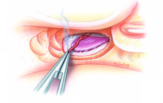 The goal of sac decompression is not merely to identify its edge, but rather to remove bone completely from its lateral surface along with 1 to 2 mm of surrounding dura. Care must be taken to avoid injury to the endolymphatic aqueduct where it penetrates the otic capsule superiorly. While the entire sac is accessible in the great majority of cases, in a few percent it may lie either predominantly or even completely deep to the posterior semicircular canal. A small vessel typically traverses the apex of the sac. It is often injured during bone removal and must be controlled with either bipolar cautery or an absorbable gelatin sponge pledget.