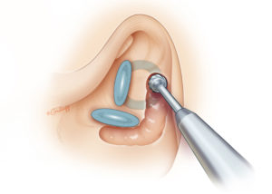 Labyrinthectomy may be effective in alleviating medically refractory vestibular symptoms in an ear with no useful hearing. The goal is not to merely open the labyrinth, but to remove all five inner ear neuroepithelial elements (three semicircular canal ampullae and two otolithic organs: utricle and saccule). The procedure commences with drilling troughs parallel to the middle and posterior fossa dural plates with a cutting burr. This enables drilling toward the facial nerve with greater stability by using the side of the burr to cut through the hard otic capsule bone rather than the tip which is less controllable.