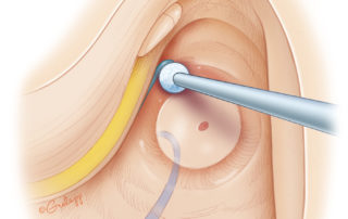 Using a diamond burr and copious irrigation, the last portions of the lateral and posterior semicircular canals are removed. The remnant of the superior semicircular canal lies deep with the arcuate artery in the center of its loop.