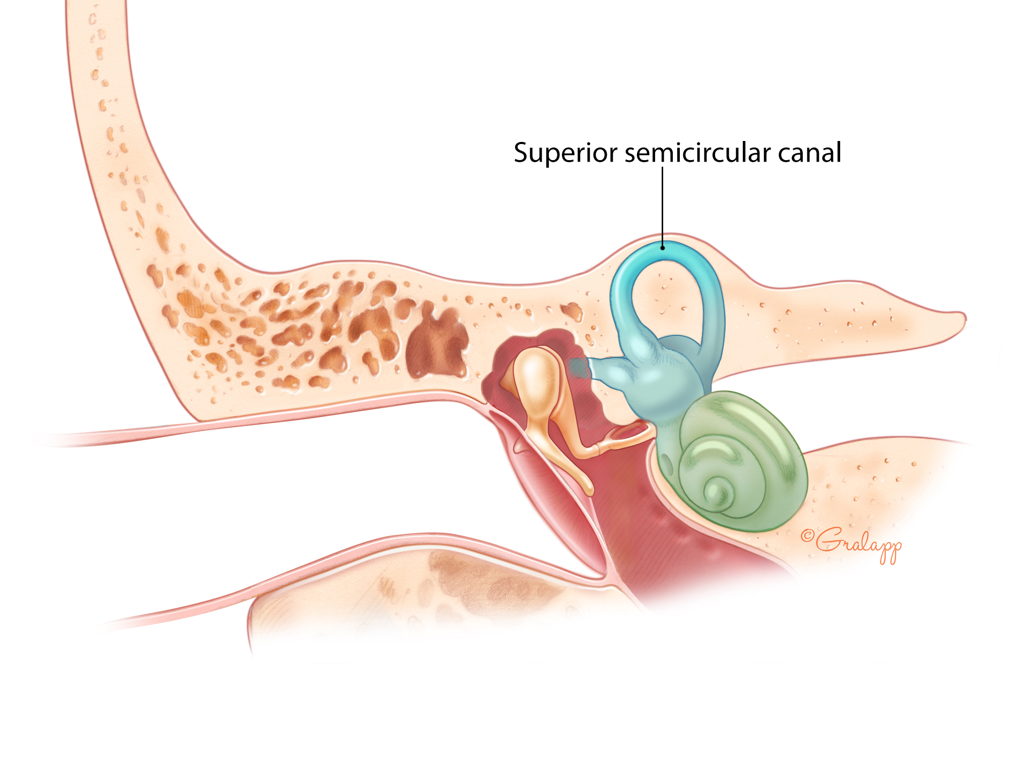 Coronal view of the temporal bone depicting a normal superior semicircular canal.