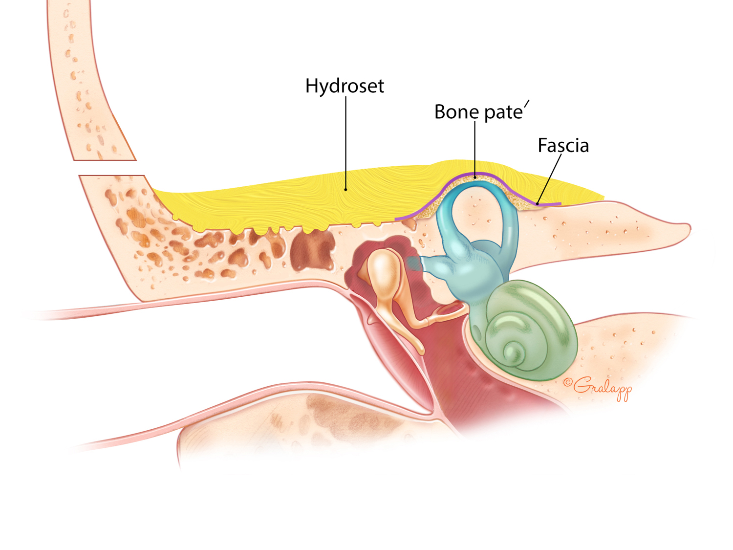 Coronal view of completed resurfacing repair of a superior semicircular canal fistula.