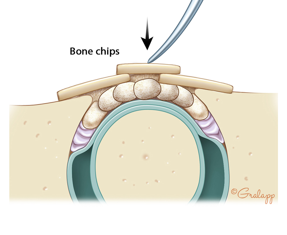 Bone chips cover the site of the fistula.