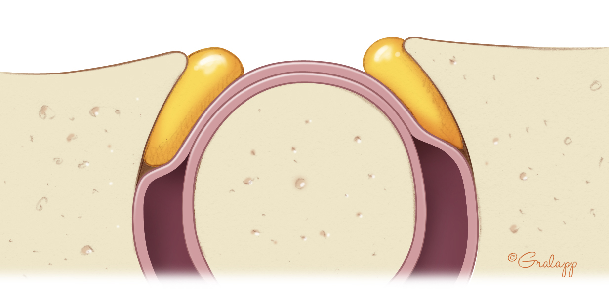 Bone wax is an alternative means of plugging a dehiscent semicircular canal.