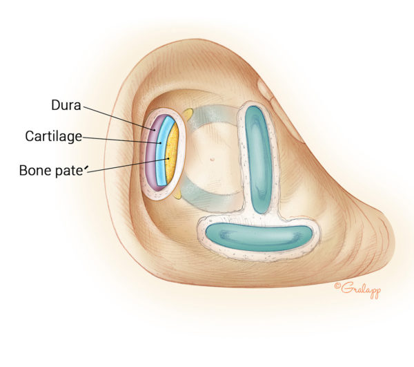 Superior Semicircular Canal Dehiscence – Oto Surgery Atlas