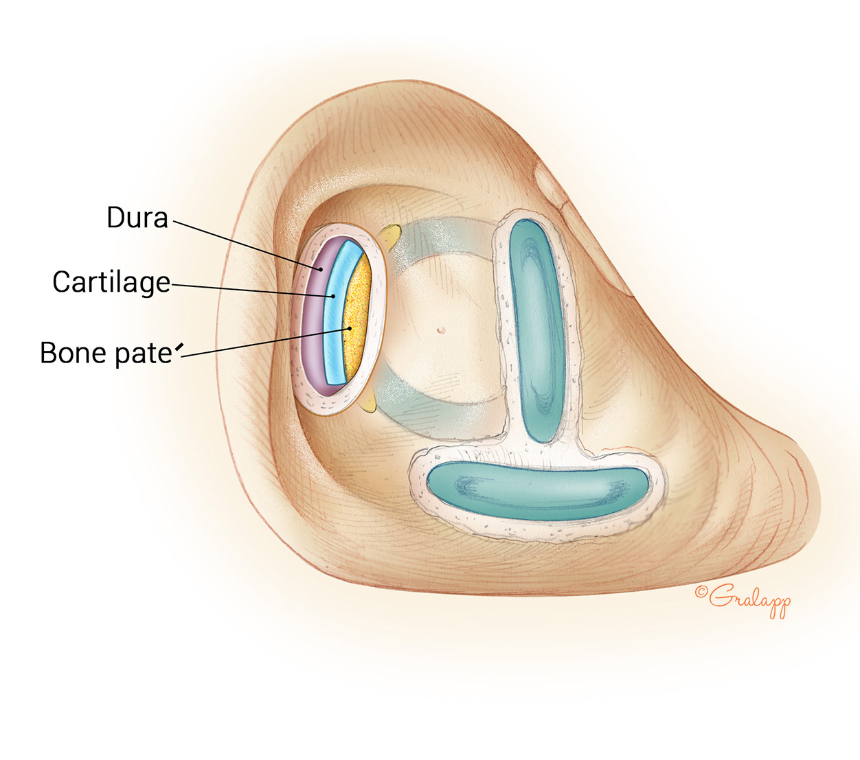 Transmastoid dehiscence repair with cartilage and bone paté.