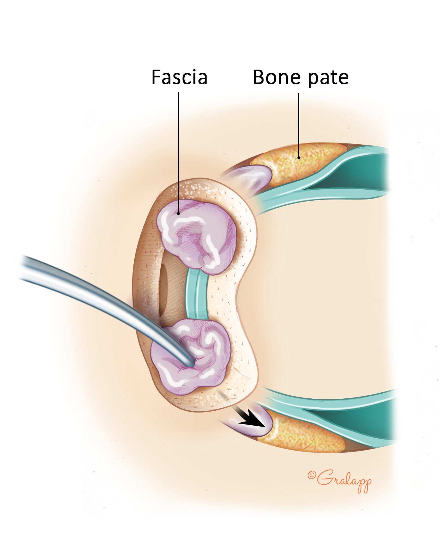 Transmastoid superior canal plugging using bone paté and fascia.