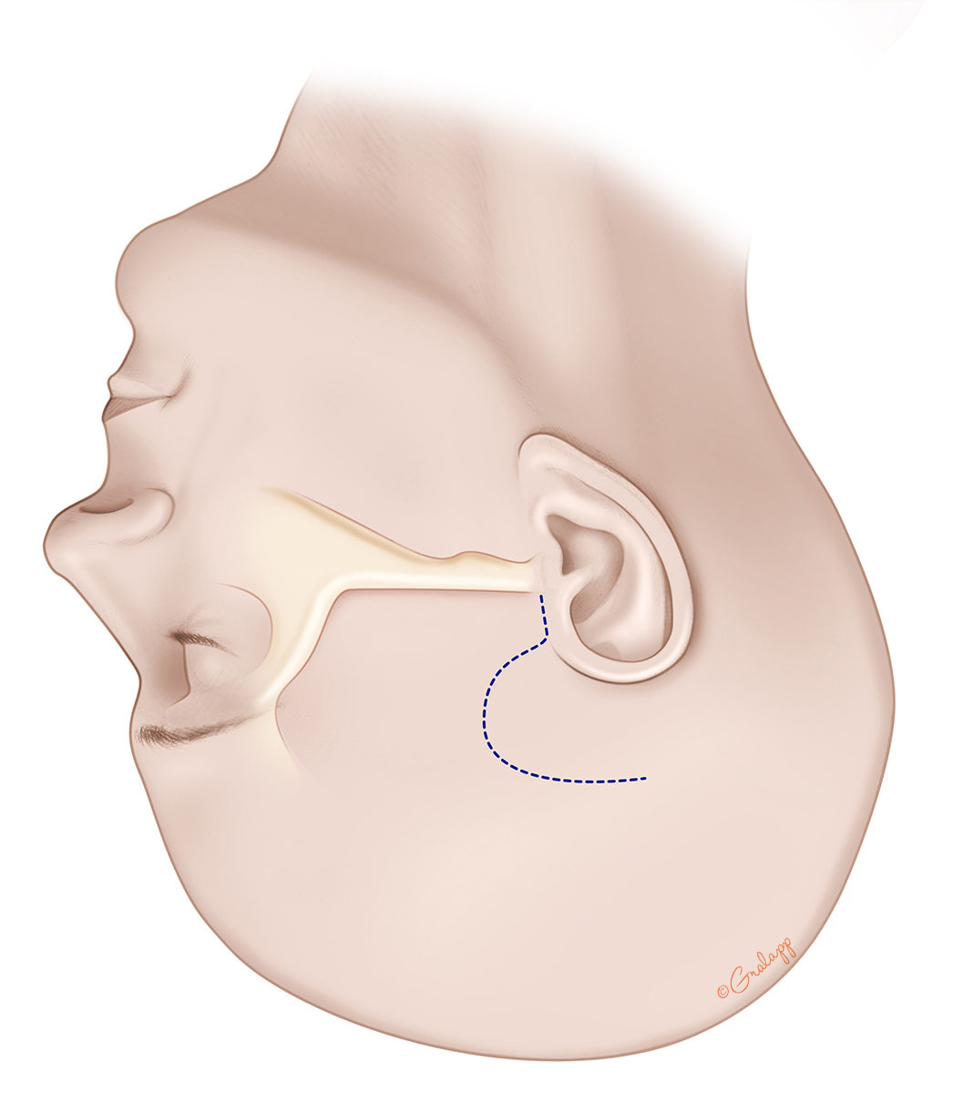 Incision used for the small middle fossa craniotomy needed in superior semicircular canal dehiscence repair. Only a racing stripe of shaving is needed.