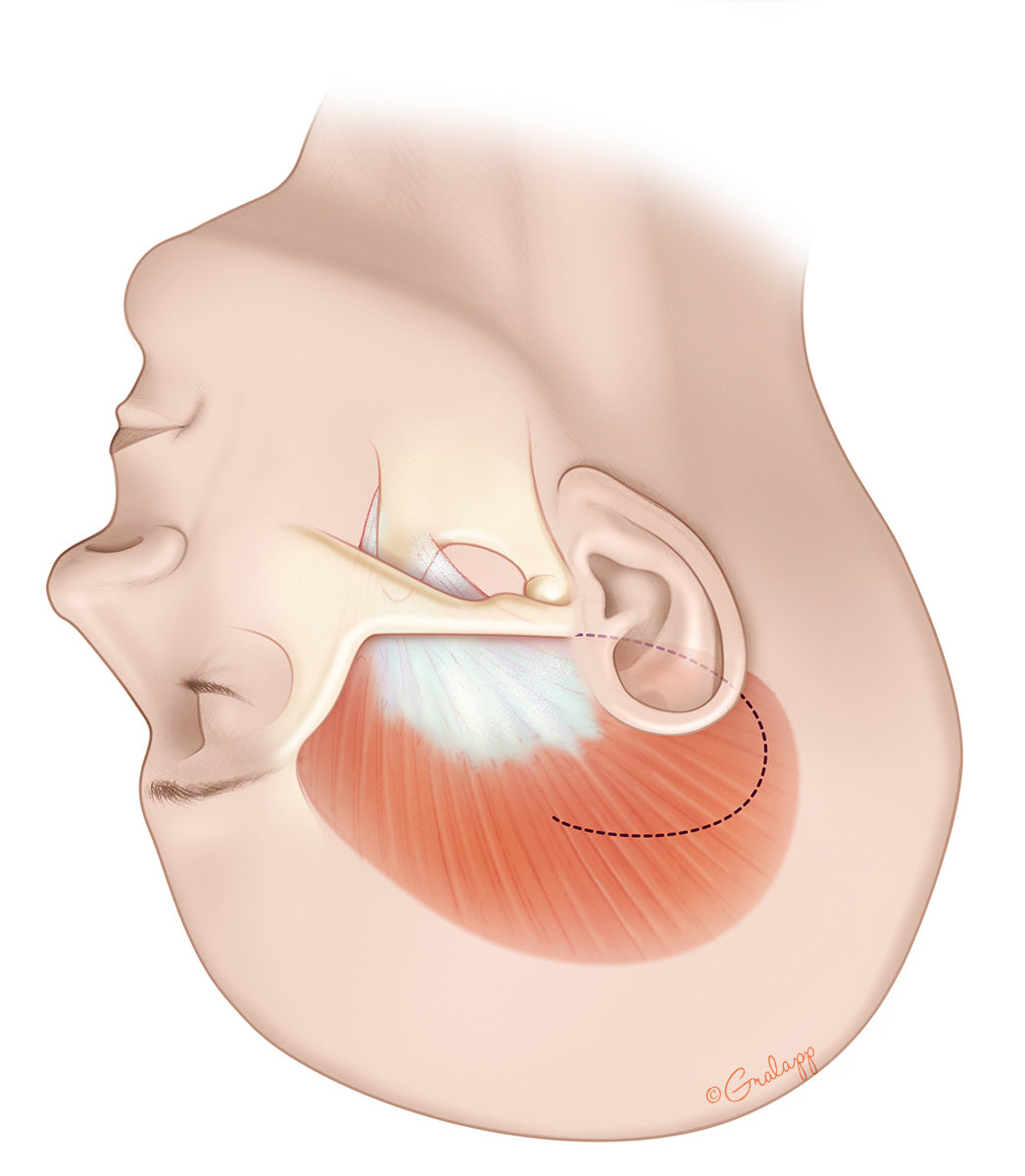 A flap of temporalis muscle is developed opposite to the skin flap. The temporalis muscle is thinner posteriorly.