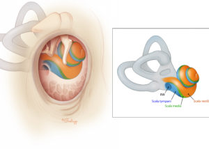 Anatomical view of the inner ear scalae in relation to the ear canal, ossicles, and tympanic cavity. Note the extension of the basal turn of the cochlea inferior to the round window, and the hook of the scala media as it approaches the vestibule. The goal of cochlear implantation is atraumatic placement of the electrode array into the scala tympani. Whether this is performed through the round window or cochleostomy, a solid grasp of the location and interrelationships of the scalae is needed to avoid additional cochlear injury and potential reduction in performance. RW, round window.