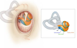 Anatomical view of the inner ear scalae in relation to the ear canal, ossicles, and tympanic cavity. Note the extension of the basal turn of the cochlea inferior to the round window, and the hook of the scala media as it approaches the vestibule. The goal of cochlear implantation is atraumatic placement of the electrode array into the scala tympani. Whether this is performed through the round window or cochleostomy, a solid grasp of the location and interrelationships of the scalae is needed to avoid additional cochlear injury and potential reduction in performance. RW, round window.