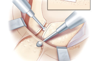 A shallow well can be drilled to accept the electronics casing of the receiver–stimulator snugly. Device-specific templates are used to ensure the correct location and orientation of this well. Bone removal is performed under the posterior skin flap, and adequate retraction and adjustment of the surgeon’s angle of view is needed to perform this in a safe manner. Initial bone removal can be performed with a large cutting burr, with a smaller cutting or diamond burr being used to create a sharp ledge anteriorly to prevent migration of the device over time. A smaller burr is used to drill a trough from the well to the mastoid cavity. Overhangs can be left to help hold the electrode lead securely. Many surgeons have completely dispensed with drilling such a well. The creation of a secure soft-tissue pocket alone is sufficient to prevent migration. This is a particular consideration in young children with thin bone. In these cases, avoiding the creation of a well may reduce the risk of intracranial complications. A small piece of muscle and fascia can be harvested from the posterior aspect of the incision for later use in closure. This is then an opportunity to achieve hemostasis fully before opening the device onto the operative field.