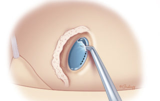The middle ear and mastoid are irrigated to remove any blood or bone dust. The device is then opened, inspected, and placed in the pocket. The anterior margin of the round window membrane is incised with a sharp pick or needle. There is more room anteriorly between the round window membrane and the underlying basilar membrane. Also, an anterior incision encourages the optimal direction of array insertion. When a sufficient amount of membrane has been incised, the opening will be visible without the need for tissue excision or flap creation. Similar to stapedectomy, the surgeon should avoid suctioning directly over the incision to maintain the perilymph within the scala. The application of additional topical steroids and hyaluronic acid may be beneficial at this step.