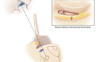 In some cases, the surgeon’s view of the round window may be obstructed by the facial nerve despite optimal drilling. In such cases, the surgeon will usually still have a view anterior and inferior to the round window along the inferior side of the promontory, where a cochleostomy can be created. Identification of this region may be facilitated if there is even a slight view of the anterior margin of the niche.