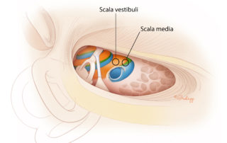 Suboptimal cochleostomy locations. Placement of a cochleostomy just anterior to the round window risks direct damage to the basilar membrane, spiral ligament, and enters into the scala media. Similarly, placement of a cochleostomy superior to the round window will enter the scala vestibuli. Both of these approaches are to be avoided if possible to minimize the risk of trauma and ensure that the array remains within the scala tympani. Intentionally drilling in these areas or extending a scala tympani cochleostomy into the other scala may be needed if there is fibrosis or ossification obstructing the lumen of the scala tympani.