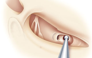 A small diamond burr is used at low speed to drill a cochleostomy. The direction of bone removal should be in the anterior–superior direction for optimal cochleostomy. Drilling directly anterior risks moving tangential to the inferior portion of the basal turn. Care should be taken to attempt to identify and preserve the endosteum over a wide area. The endosteum can then be entered with a sharp hook. Avoid drilling directly into the inner ear to minimize trauma. Such an approach minimizes the risk of damage to the basilar membrane (dashed line) and remaining neural elements.