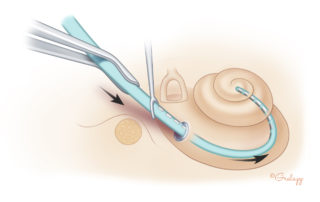 The electrode array is gently inserted into the inner ear. A similar approach is used whether through the round window or a cochleostomy. The array is directed anteriorly in the direction of the basal turn. A combination of forceps and “claw” guides can enable a slow and steady insertion. Many surgeons advocate a slow insertion (over 1 minute in duration). This may decrease trauma to cochlear tissues by allowing the equilibration of perilymphatic pressures changes from the volume of the array. Similarly, slow insertion speeds may reduce trauma from friction to the anti-modiolar wall.