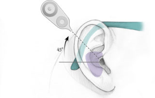 Planning the placement of the receiver–stimulator should allow sufficient room between the pinna and the headpiece to enable the comfortable use of a behind-the-ear processor and eyeglasses. Approximately 3 to 4 cm should be left between the ear canal and the anterior edge of the device, which then provides additional distance to the magnet and headpiece. The device is angled up at about 45 degrees from the linea temporalis, which places it behind the bulk of the temporalis muscle.