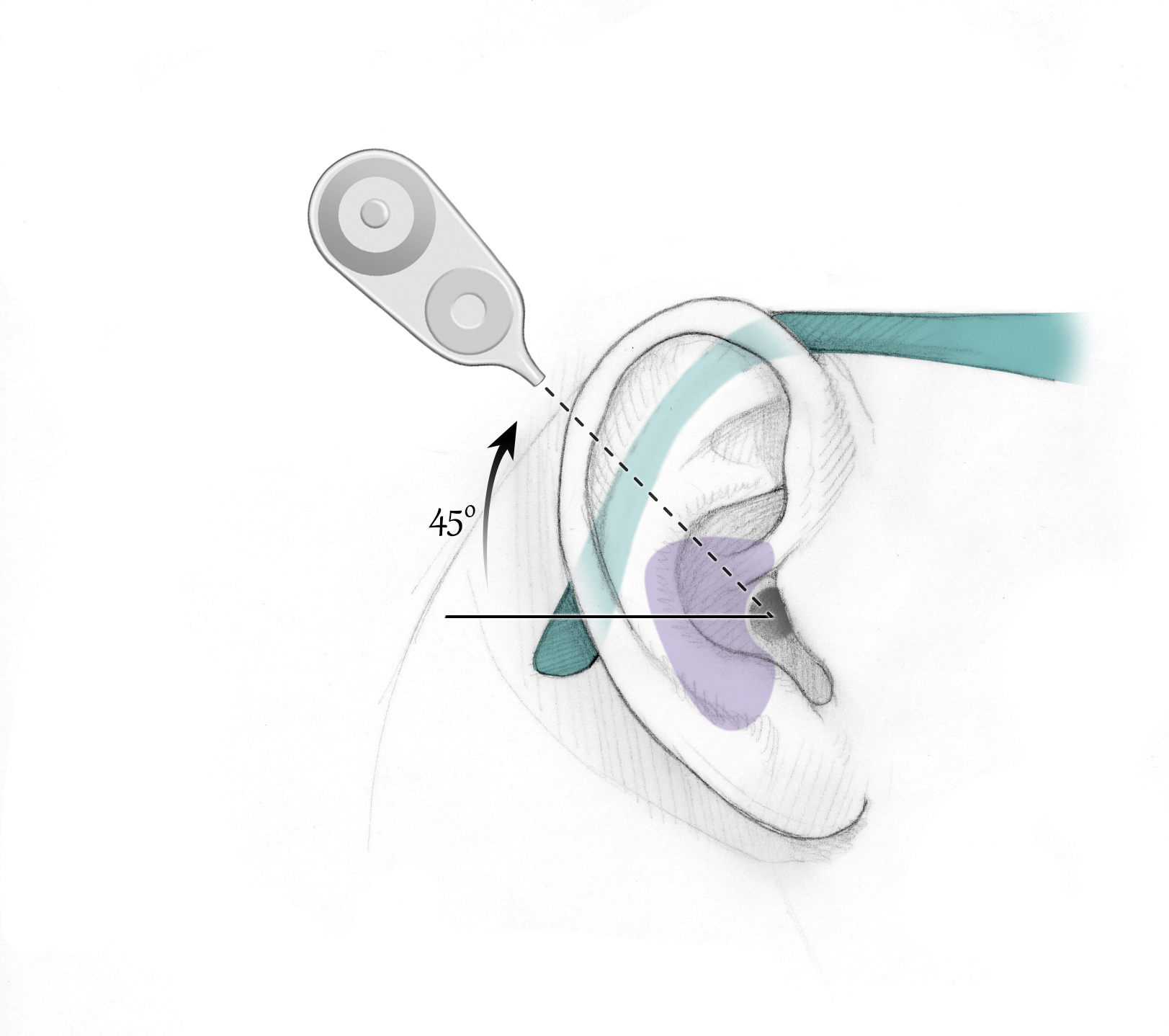 Cochlear Implant Surgery – Oto Surgery Atlas