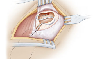 The periosteal incision is closed tightly over the anterior portion of the receiver–stimulator. These sutures help anchor the device in the pocket and secure it in the bony recess if one was created.