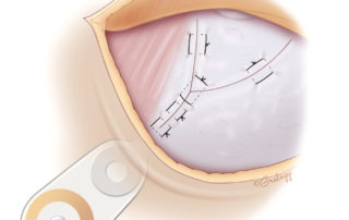 The anteriorly based periosteal flap is closed over the mastoid cavity, providing separation between the device and the skin incision. The skin is then closed and a mastoid pressure dressing applied for 24 hours.