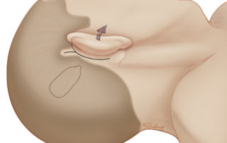 A postauricular incision is most commonly used for cochlear implantation. The superior aspect of the incision can be continued anteriorly or extended superiorly. This modification can provide additional ease of exposure for creating a well to seat the receiver–stimulator. Minimal or no shaving of hair is required if drapes are secured sufficiently to adjacent skin. Sufficient space (at least 1.5 cm) between the incision and the anterior aspect of the implant should be allowed to minimize the chance of device extrusion through the incision.