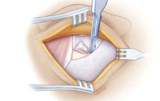 The skin incision is carried down to the level of the temporalis fascia and mastoid periosteum. Minimizing anterior dissection along the temporalis muscle can reduce postoperative facial edema. A separate anteriorly based periosteal flap is created, which can be closed over the mastoidectomy and device at the conclusion of the procedure. Avoiding electrocautery for this step minimizes tissue shrinkage and facilitates closure. In small children where the flap is quite thin, the periosteum and muscle can be left attached to the skin. An extension of the periosteal incision posteriorly, curving up along the linea temporalis, allows for retraction of the temporalis muscle superiorly. This can help when creating the soft-tissue pocket for the receiver–stimulator.