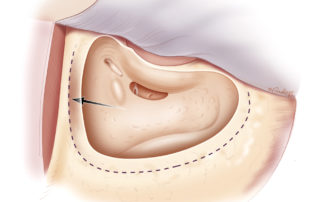 Mastoidectomy is then performed. Unlike the conventional technique for chronic otitis media, the surrounding cortex is not “saucerized.” Instead, bony overhangs are left superiorly, posteriorly, and inferiorly to help retain the coiled electrode lead. The creation of such overhangs should not be performed at the expense of safety. By carefully controlling the angle of view, the surgeon can ensure that the burr is always seen, even while creating the overhang. Most cochlear implant recipients have normally developed and aerated mastoids. Some air cells can be left intact provided that adequate exposure to completely open the facial recess is provided. The facial recess is then performed as described elsewhere. Adequate middle ear exposure through the facial recess is critical for array insertion. The facial nerve is identified through thin bone, as is the chorda tympani. The removal of bone anterior to the facial nerve will enable optimal view of the round window niche. Exposure of the incudostapedial joint and stapedial tendon can provide valuable landmarks. The incudal buttress is left intact.