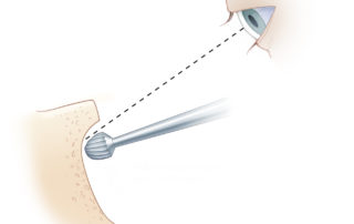 Depiction of the importance of adjusting the surgical angle of view while leaving cortical overhangs during mastoidectomy. By moving the microscope appropriately, the surgeon can maintain continuous line-of-sight with the burr, ensuring that no structures are inadvertently injured.