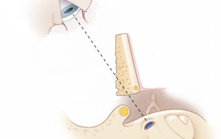 It is critical that the posterior external canal wall be adequately thinned to provide optimal exposure of the round window. The canal moves anteriorly as it extends medially, and following its contour to maintain uniform thickness is essential. Incomplete canal wall thinning will prevent identification of the chorda tympani, and leave the facial recess significantly smaller than it should be. Similarly, the persistence of medial canal bone can prevent sufficient exposure of the bone anterior to the facial nerve, and prevent the identification of the round window niche.