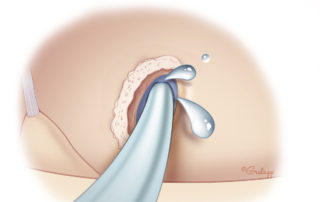 Entering the inner ear may precipitate a spinal fluid leak. This may either be brisk (“gusher”) or slow (“oozer”). In the case of a slow leak, the flow of spinal fluid may be controlled with the full insertion of the electrode array and placement of surrounding tissue as described above. In more brisk leaks, as is commonly seen in congenitally malformed inner ears, additional packing may be required to control the leak.