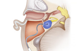 Cochlear implantation of a malformed inner ear presents special challenges. Because the spiral geometry of the cochlea may be altered (e.g., incomplete partition) or absent (e.g., common cavity), the relationship between the electrodes and the auditory nerve may be altered. In addition, because the cochlear modiolus may be malformed, a connection between the perilymph and cerebrospinal fluid may exist at the lateral terminus of the internal auditory canal.