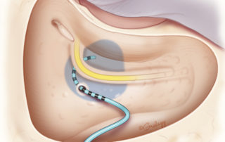 In cases of common cavity malformation, cochleostomy can be performed posterior to the facial nerve. Drilling of the facial recess, while also allowing access to the cavity, is typically unnecessary. A more posterior cochleostomy also allows for better access in case packing of a CSF leak is required.
