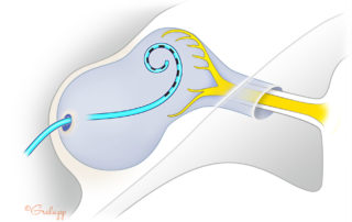 A coiled electrode may position more centrally in the deformed inner ear, more remote form the neural elements.