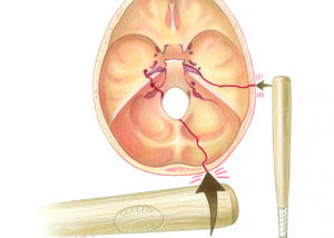 Middle Ear & Mastoid – Oto Surgery Atlas