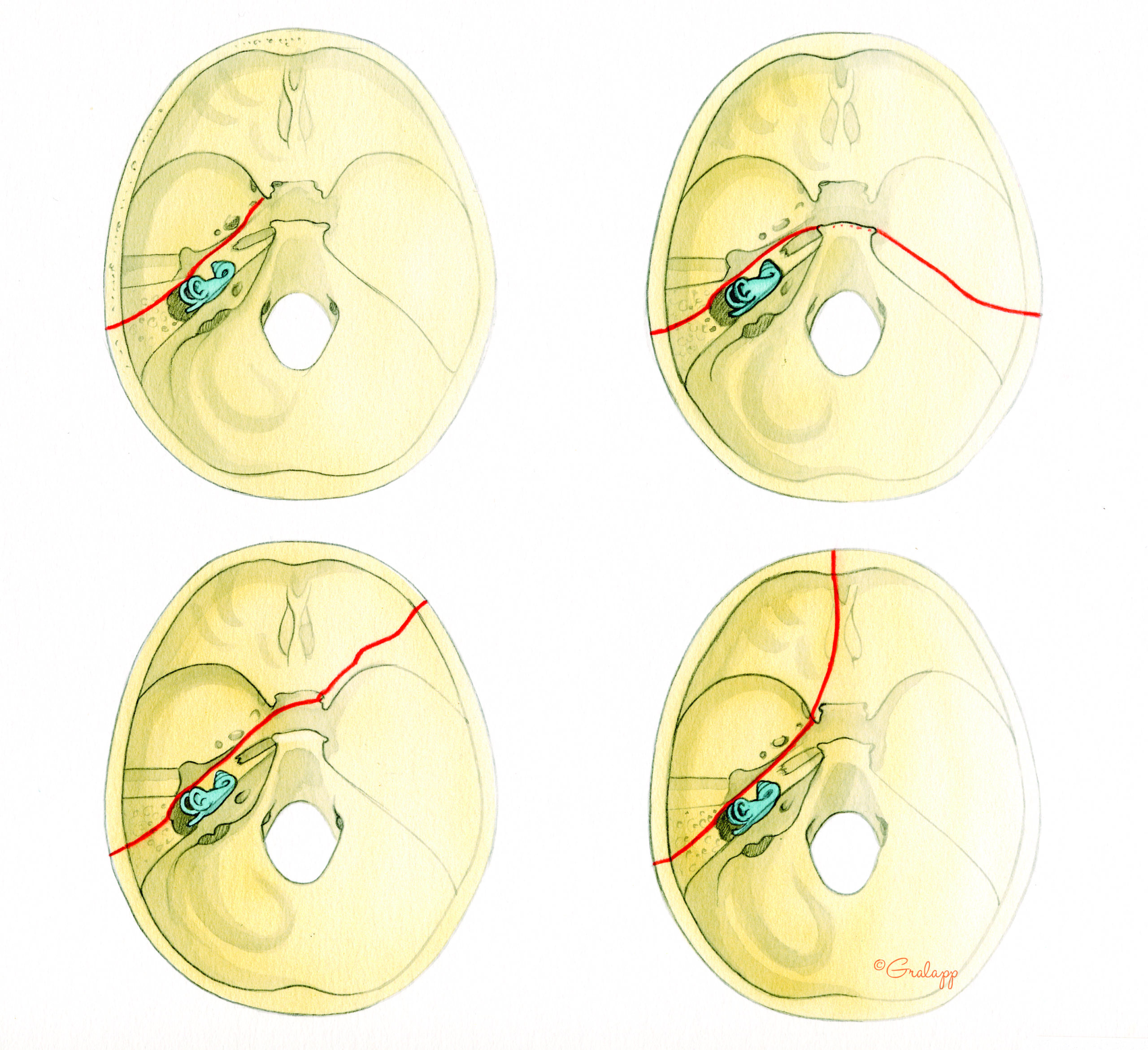 inner ear bone broken