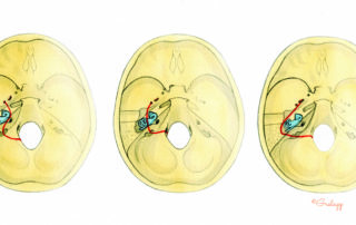 Possible courses of transverse temporal bone fractures: In its course from the foramen magnum to the floor of the middle fossa, the transverse fracture may pass either lateral to, through or medial to, the otic capsule. The most common path is directly through the otic capsule, thereby disrupting the inner ear (center). In the rare case where the fracture spares the otic capsule by passing medial to it (left), the facial and vestibulocochlear nerves are at risk as the fracture traverses the internal auditory canal. Also rare, the fracture may spare the otic capsule by passing lateral to it through the middle ear (right).