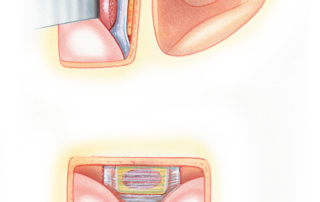 Narrow deficiencies in the temporal floor can be repaired with a soft-tissue graft alone, but a supplemental osseous layer is desirable. Wider defects should be bridged by a bone graft, as depicted here, in addition to a connective tissue sheet.