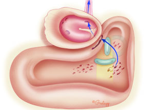 Multiple pathways exist for CSF leakage through the ear. Most common are traumatic and spontaneous leaks that occur via the middle fossa floor (tegmen tympani and mastoideum). Following skull base tumor surgery, the leakage from the posterior fossa flows via perilabyrinthine tracts as shown in the illustration above. Finally, leak may flow though the inner ear, especially when congenitally malformed, or following cochlear implant surgery. (see 11.3 Cochlear Implant Surgical Variations)