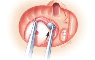 To reduce the likelihood of mucocele formation, mucosa from the middle ear is removed.