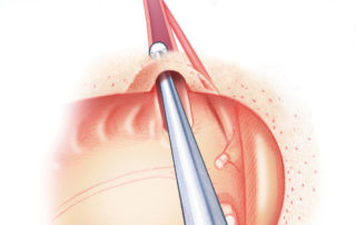 Using a diamond burr, the middle ear orifice of the Eustachian tube is funneled.