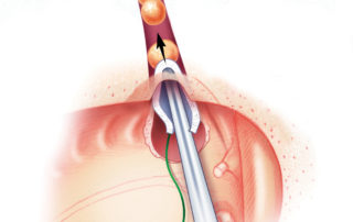 The Eustachian tube is obliterated with bone wax. A series of small “peas” of bone wax are impacted sequentially with a ¼ inch cottonoid pledget.