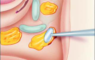 In a hearing ear, the perilabyrinthine cell tract can be meticulously sealed with bone wax.