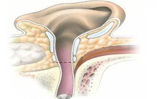 The goal of ear canal closure during skull base surgery is to create a sealed cavity into which an adipose tissue graft or muscle flap can be placed. Prior to obliterating the surgical defect, all skin and as much mucous membrane as possible must be removed from the defect. When the dura has been violated, it is essential that the closure be watertight to avoid CSF leakage. This requires a multiple layer closure and meticulous technique. It is usually done in the early stages of the procedure, although it can be accomplished at any convenient stage. The ear canal is initially transected at the level of the bony cartilaginous junction as depicted here. For the technique of meatal closure employed in temporal bone resection for carcinoma of the ear canal, see 13.2 Lateral Temporal Bone Resection.