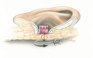 Completed meatal closure involves three layers: the everted meatal skin, the intervening fibrous tissue, and an inner periosteal-fascial flap. Of the three, the middle layer is often least substantial.