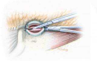 Prior to transection of the anterior aspect of the cartilaginous ear canal, a clamp is insinuated between it and the parotid fascia. This maneuver reduces the likelihood of bothersome bleeding from the parotid gland, and thus speeds the procedure.
