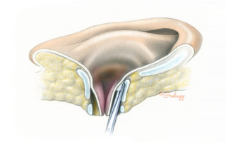 The skin of the lateral portion of the ear canal is dissected from its underlying cartilage in retrograde fashion. When approaching the lateral margin of this elevation, care must be taken to avoid buttonholing the flap. This is unlikely to occur anteriorly as the tragus is long and broad and there is no need to dissect all the way to its free edge. Posteriorly, however, the canal skin abruptly drapes over the conchal margin where it is vulnerable. Keeping a finger in the meatus while dissecting from the postauricular side provides useful tactile feedback as to the remaining length of mobilization required.