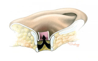 The skin of the lateral portion of the ear canal is dissected from its underlying cartilage in retrograde fashion. When approaching the lateral margin of this elevation, care must be taken to avoid buttonholing the flap. This is unlikely to occur anteriorly as the tragus is long and broad and there is no need to dissect all the way to its free edge. Posteriorly, however, the canal skin abruptly drapes over the conchal margin where it is vulnerable. Keeping a finger in the meatus while dissecting from the postauricular side provides useful tactile feedback as to the remaining length of mobilization required.