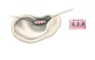 While being stabilized with the traction sutures, a series of interrupted vertical mattress sutures are used to seal the meatus. The lower pass of these sutures is placed rather far down the skin cuff to help coapt the long sleeve of subcutaneous tissue. Once these sutures have been placed, the everted canal remains in place and the traction sutures can be removed or tied to serve as a subcutaneous closure at the extremity of the suture line.