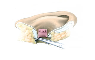 Working from the postauricular side, the canal cartilage is removed or scored to break its spring. This facilitates coaptation of the submeatal soft tissues to serve as a second closure layer.